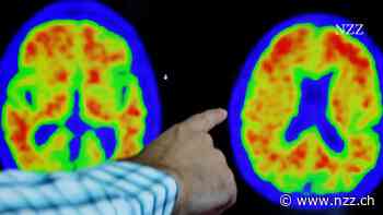 Studie: Neues Antikörper-Medikament verlangsamt das Fortschreiten von Alzheimer deutlich