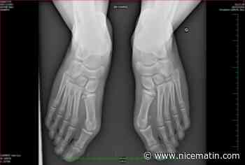 "Oignon" du pied ou hallux valgus chez l’enfant: repérer et traiter au plus vite