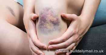 Four blood cancer red flags you should never ignore