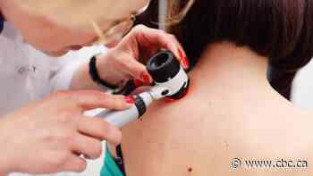 Melanoma can be deadly. But experts say it's easy to protect your skin and catch it early