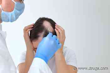 People With Alopecia Have Higher Risk for Inflammatory Arthritis