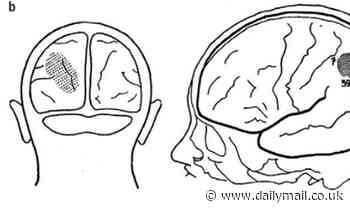 Spanish man who survived being shot in the head woke up to find he could now see the world backwards