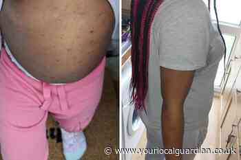 Mum placed in Mitcham house 'infested by bed bugs'