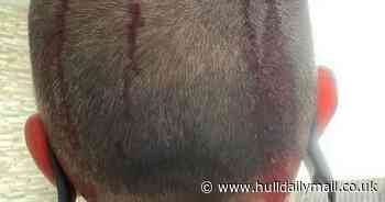 Runner left covered in blood after buzzard sinks talons into his head