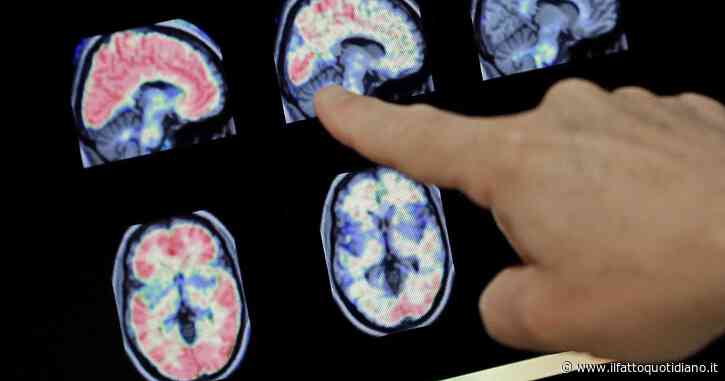 Sclerosi multipla, così gli anticorpi contro il virus Epstein-Barr attaccano una proteina nel cervello e nel midollo spinale