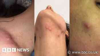 Cheap blood pressure drug could treat acne, Southampton study finds