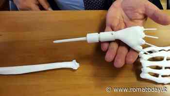 Evita l'amputazione della mano con una protesi su misura realizzata da una stampante 3D