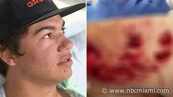 ‘Got Blindsided': Man Speaks Out From Hospital Bed After Suffering Shark Bite in Florida Keys