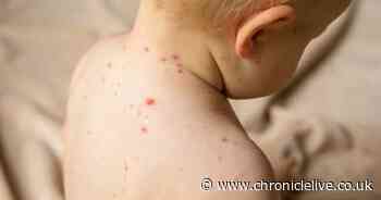 NHS signs and symptoms of measles in children after warning of rise in cases across UK