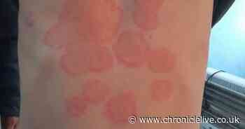 Symptoms of unusual fungal disease that causes scaly rashes on body - and could become more common