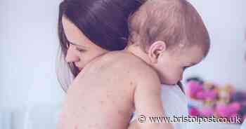 Warning issued as Victorian disease measles reported in 17 European countries