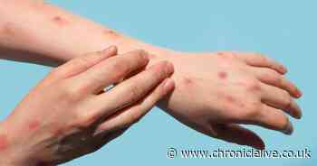 UKHSA issues urgent monkeypox warning amid increase in UK cases as vaccine deadline looms