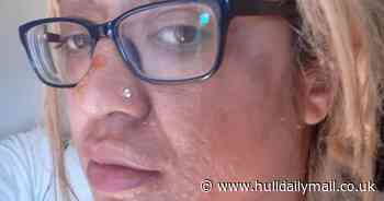 Mum left badly burned after trying TikTok egg 'hack'