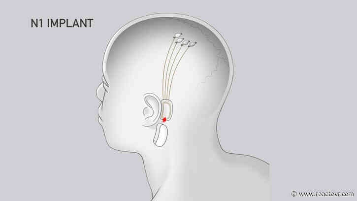Elon Musk’s Brain-chip Startup Approved by FDA for Testing on Humans