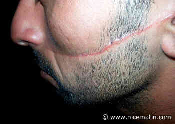 "Plus de huit ans après, c’est très dur": défiguré en 2014 à Nice, il obtient enfin justice