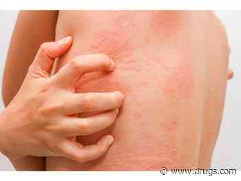 Atopic Dermatitis Tied to Higher Venous Thromboembolism Risk