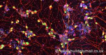 Drug found to slow progression of Motor Neurone Disease for more than six months