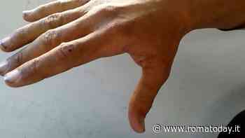 A Roma crescono i casi di scabbia