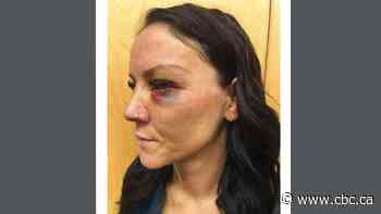 Indigenous lawyer injured during central Alberta arrest alleges RCMP used 'extreme force'