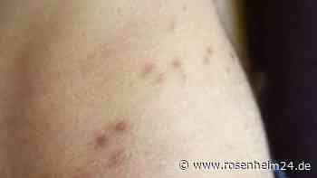 40 Prozent Rohingya in Lagern leiden an Krätze