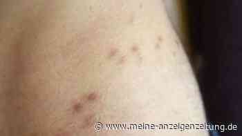 40 Prozent Rohingya in Lagern leiden an Krätze