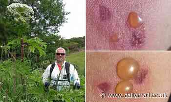 Gardener is left with painful blisters after accidentally rubbing giant hogweed on his bare arm