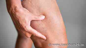 Thrombose: Fünf Anzeichen, die auf ein gefährliches Blutgerinnsel hinweisen können