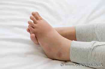 How to prevent swollen feet and ankles in the heat