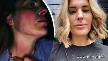 Schlimme Hotel-Attacke in Italien-Urlaub: Ö3-Moderatorin meldet sich tief gezeichnet und äußerlich verändert