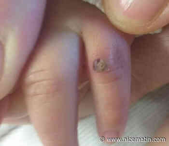 Tout ce qu'il faut savoir sur l’impétigo, cette maladie de peau fréquente chez le jeune enfant