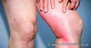 Warning signs of a blood clot you should never ignore, according to medical experts