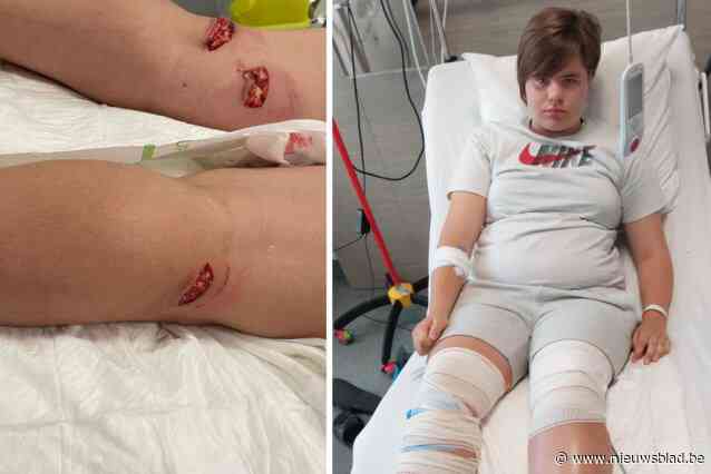 Jinte (13) loopt ernstige bijtwonden op na aanval door Mechelse herder: “Zelfs toen zijn baasje riep, wou hij niet loslaten”