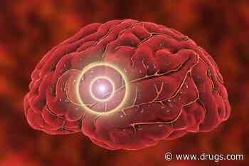 Brain 'Zaps' Might Limit the Damage From a Stroke