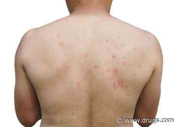 Eosinophilic Cellulitis Seems to Be Type 2 Inflammatory Disease