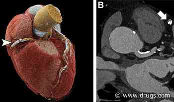 Ultrahigh-Resolution CCTA Has High Diagnostic Accuracy for Coronary Artery Disease