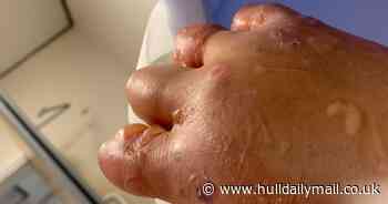 Student looks like 'Teletubby' after brushing against giant hogweed