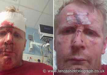 Man with Parkinson's says wrong medication dose led to fall