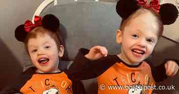 Conjoined twins survive separation surgery despite 2 per cent chance of survival