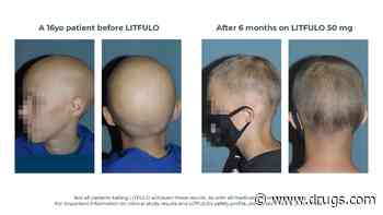 FDA Approves Litfulo for Teens, Adults With Alopecia Areata