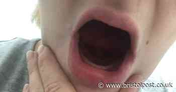 Woman lost all her teeth due to condition during pregnancy
