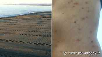 Pulci di mare, bagnanti lanciano l’allarme: ricoperti di punture dopo una giornata in spiaggia