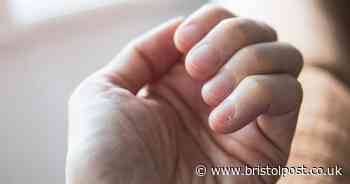 Unexpected lung cancer symptom that appears on your fingers