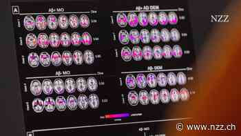 Nach dem Flop mit dem Alzheimer-Medikament Aduhelm: Biogen hofft im zweiten Anlauf auf den Durchbruch