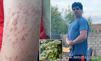 Teen is hospitalised for three DAYS after touching giant hogweed 
