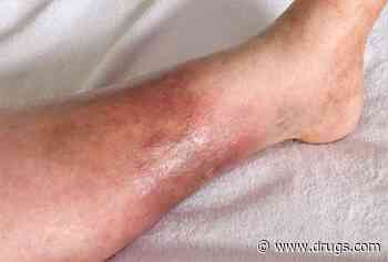 Chemotherapy-Induced Pseudocellulitis Described in Case Reports