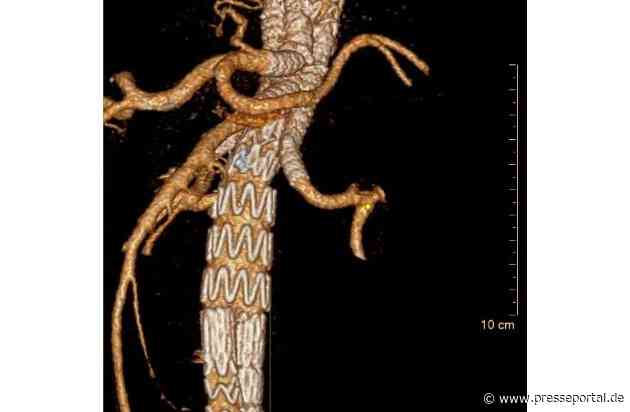 Europapremiere in der Gefäßchirurgie der Asklepios Klinik Nord - Heidberg: Erster Aorten-Aneurysma-Patient in Europa mit innovativer Therapie mittels High-End Stentgraft behandelt