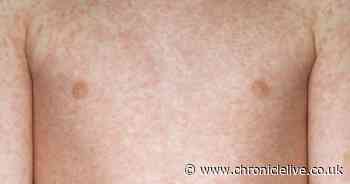 Measles warning as doctor shares symptoms parents need to look out for