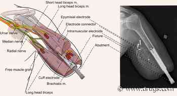 B 7/12 -- New Bionic Hand Implant Allows Control of All Fingers