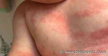 Mum who felt ‘helpless’ as her baby suffered from horrific rash praises ‘lifesaver’ £7.99 cream