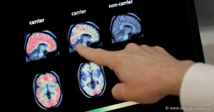 L’anticorpo monoclonale che frena il declino cognitivo nei malati di Alzheimer in attesa dell’approvazione della Fda